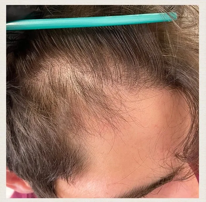 Before treatment