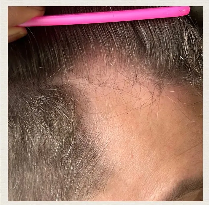 After 4 Months of treatment