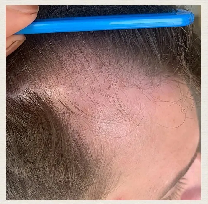 Before treatment