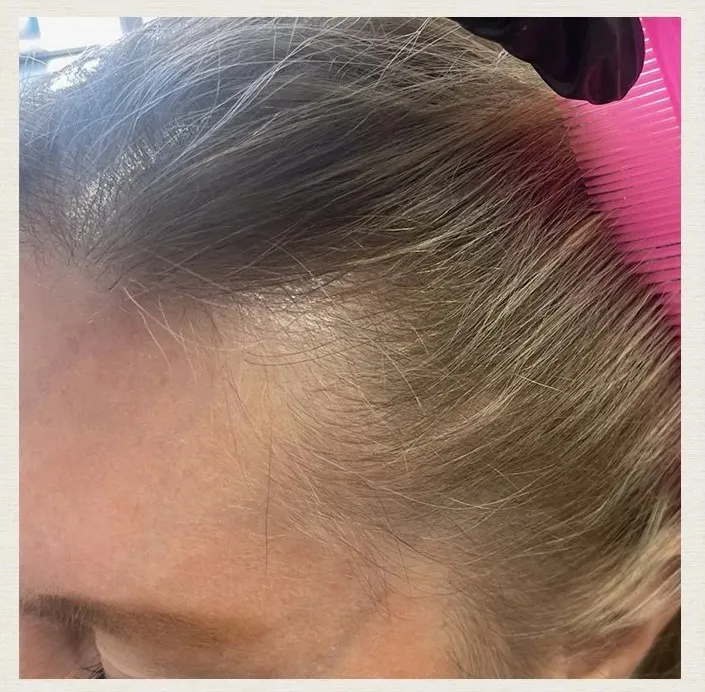 Before treatment