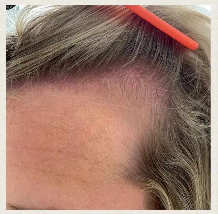 Before treatment