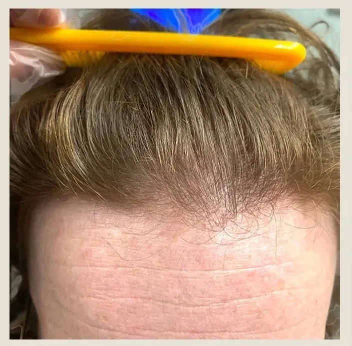 Before treatment