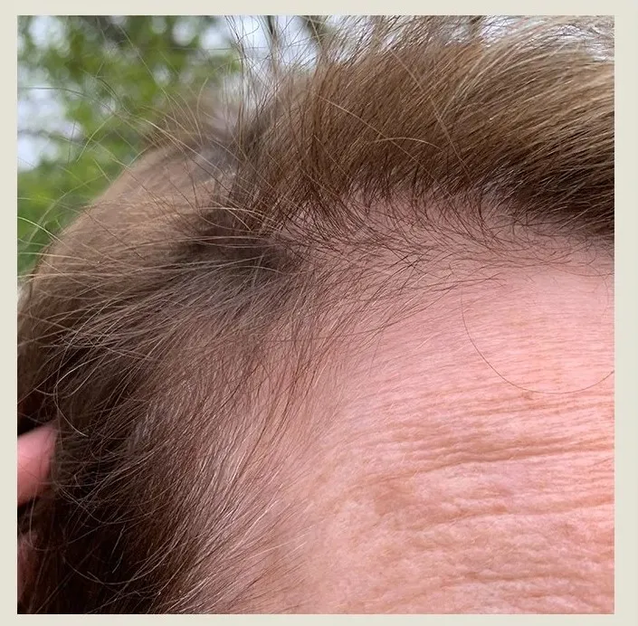 Before treatment