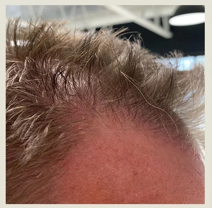Before treatment