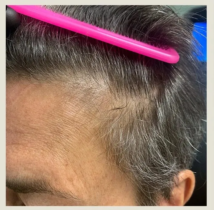 Before treatment