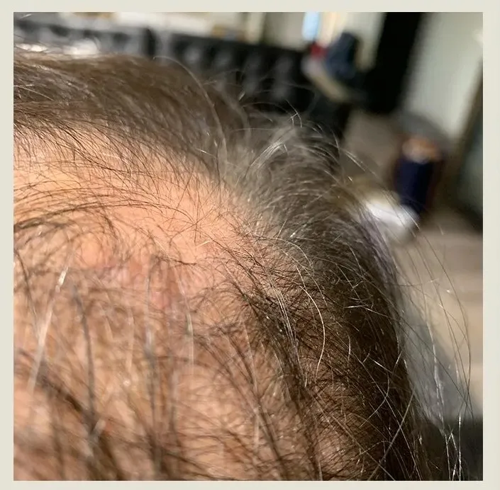 Before treatment