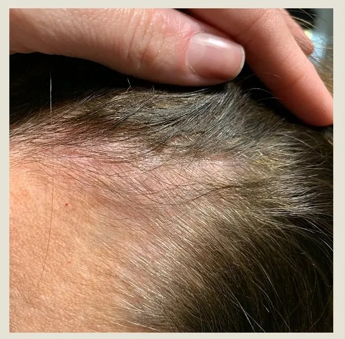 Before treatment