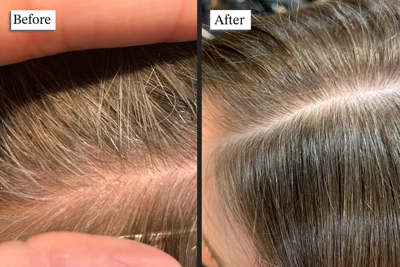 Scalp cleanse process