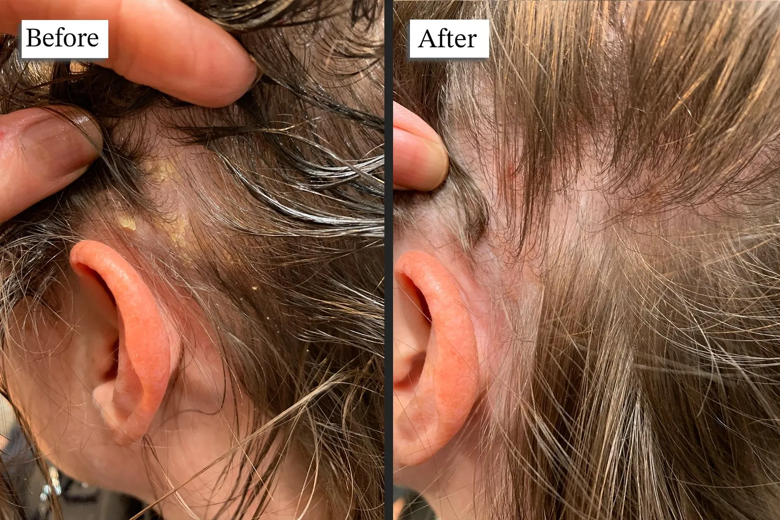 Scalp treatment results
